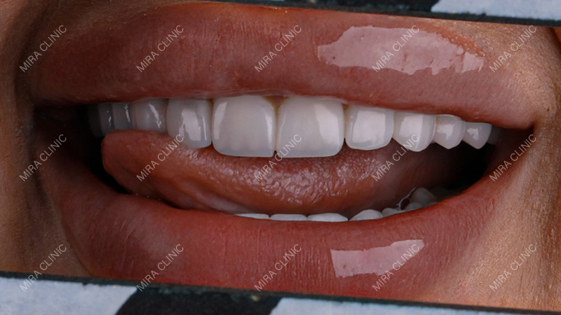 Quality Veneers